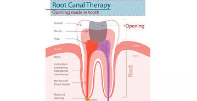 Diagram showing root canal therapy