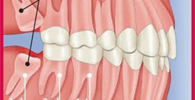 Diagram showing impacted wisdom teeth