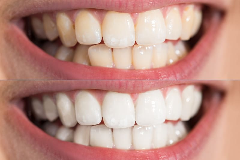 Why Teeth Whitening Is the Most Popular Dental Procedure