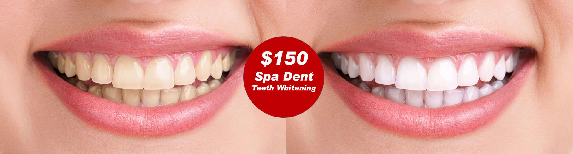 Teeth Whitening in Millwoods, Southeast Edmonton Agape Dental Millwoods