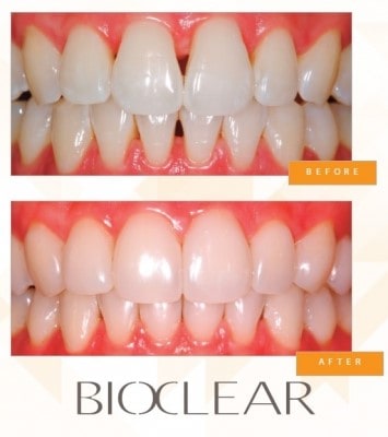 bioclear triangles dental triangle teeth veneers gaps method matrix fill closure whitehouse irvine dentistry posterior newsletter edmonton mill woods without
