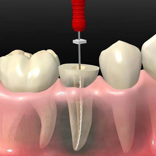 what-to-expect-after-a-root-canal-in-mill-woods,AB