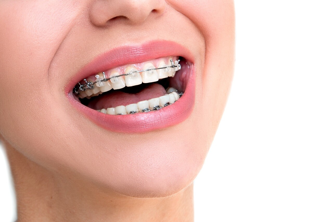 Your Guide to Oral Hygiene with Braces