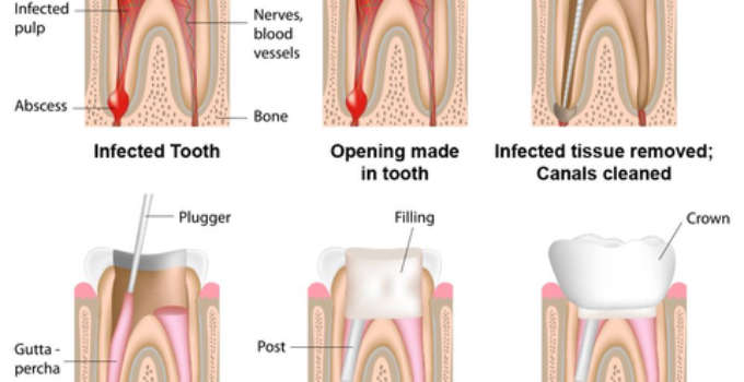 can root canal therapy save a tooth