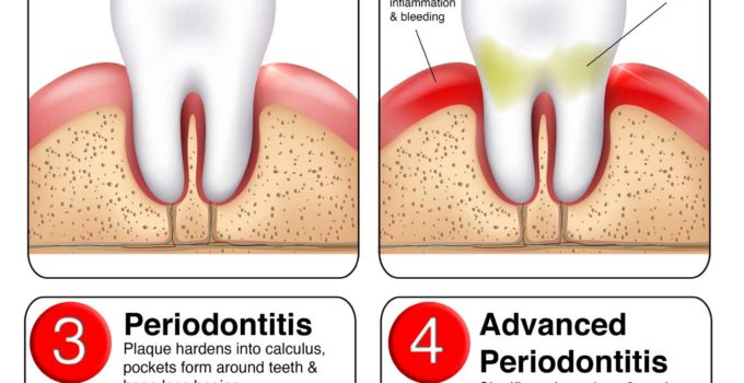 the importance of periodontal health