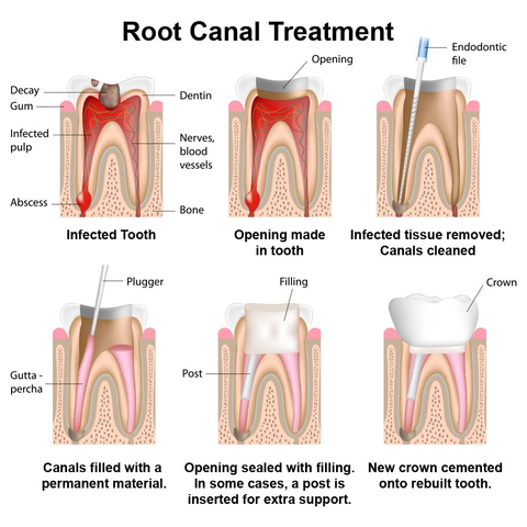 can root canal therapy save a tooth