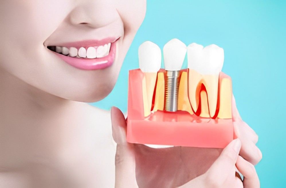 reasons to considering dental implants