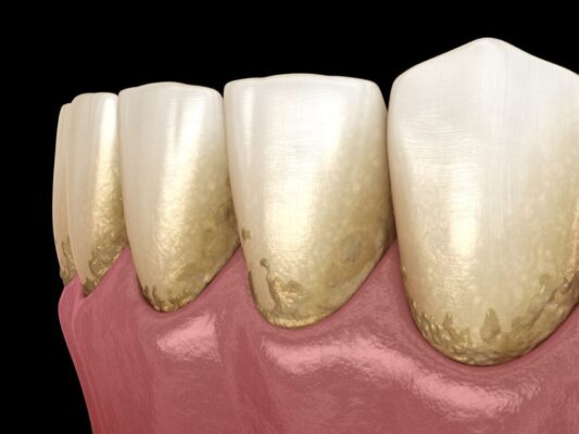 what is dental plaque and how can you get rid of it?