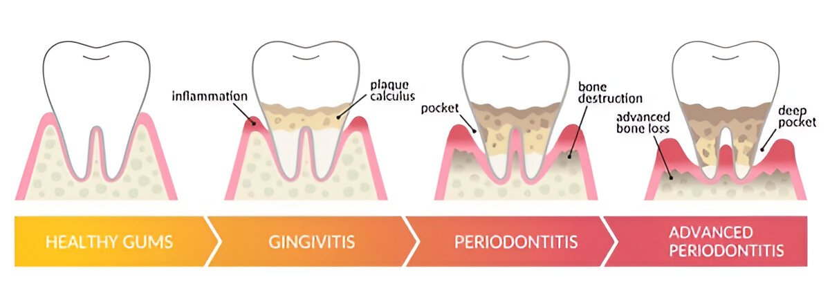 Periodontal treatment